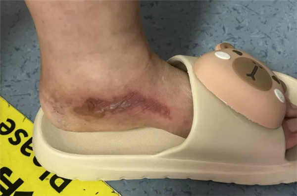 女子为防蚊往鞋里倒敌敌畏：双脚布满水泡走路困难